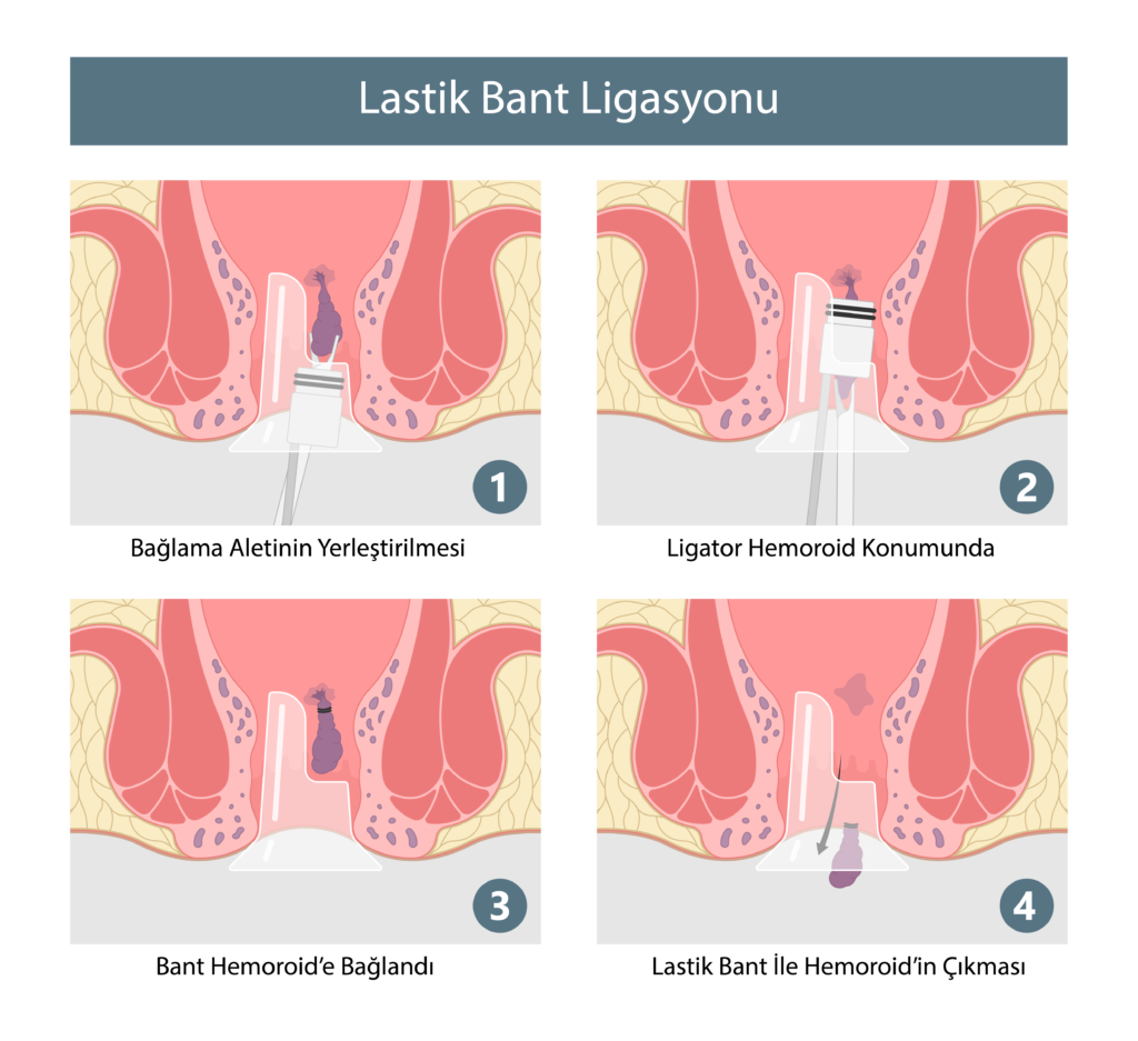 Hemoroid Tedavisi Lastik Bant Ligasyonu