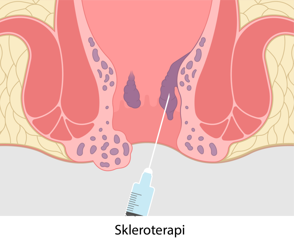 Hemoroid Tedavisi Skleroterapi