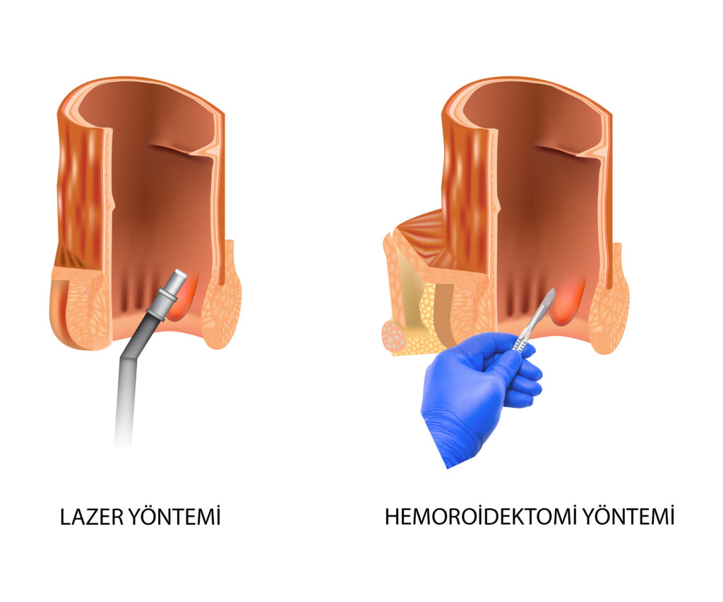 Hemoroidektomi